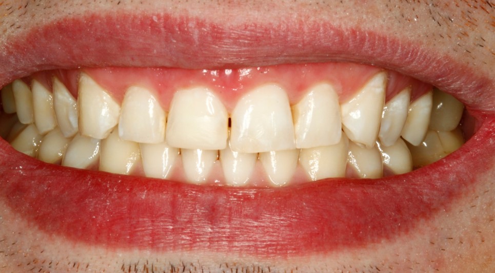 Before-and-after-front-tooth-chip-after.jpg