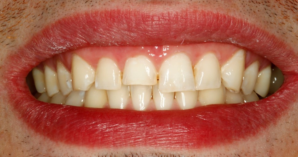 Before-and-after-front-tooth-chip-before.jpg