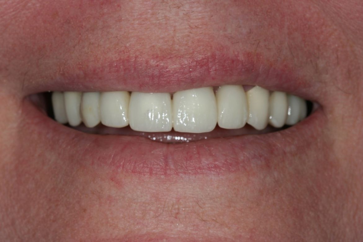before-and-after-broken-and-mising-teeth-after-1.jpg