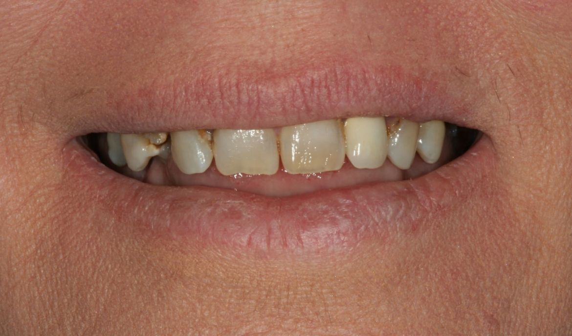 before-and-after-broken-and-missing-teeth-before-1.jpg