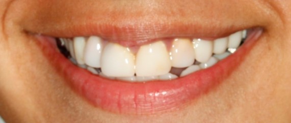 before-and-after-discolored-broken-down-teeth-in-child-smile-after.jpg