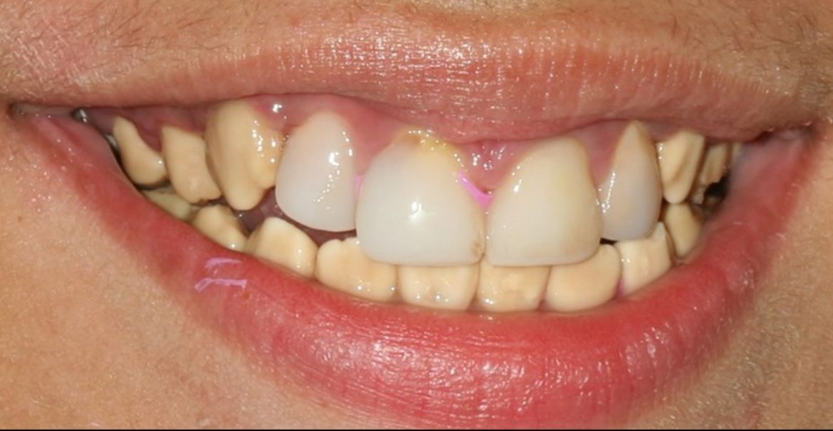 before-and-after-discolored-broken-down-teeth-in-child-smile-before.jpg