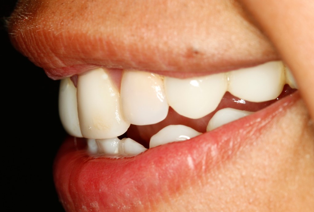 before-and-after-discolored-broken-down-teeth-in-child-smile-left-side-after.jpg