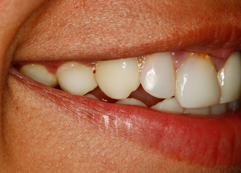 before-and-after-discolored-broken-down-teeth-in-child-smile-right-side-after.jpg
