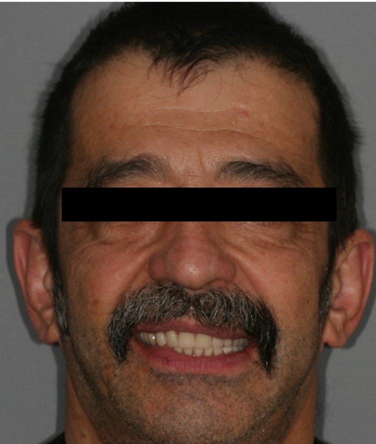 before-and-after-missing-and-malaligned-teeth-after.jpg