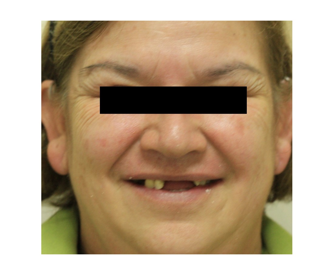 before-and-after-multiple-missing-front-teeth-before.jpg