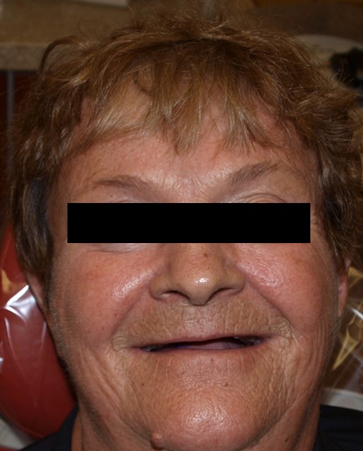 before-and-after-unesthetic-denture-before.jpg